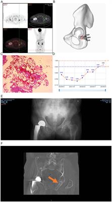 18F-AlF-NOTA-octreotide PET/CT and 3D printing technology for precision diagnosis and treatment of phosphaturic mesenchymal tumors in patients with tumor-induced osteomalacia: two case reports